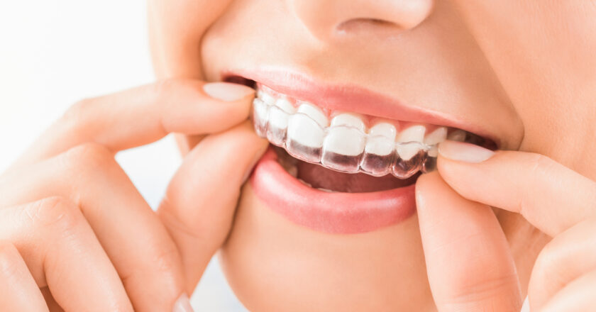 How Much Does Invisalign Treatment Cost?